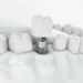 Имплантация зубов: современное решение в стоматологии от «Dali Dental Studio»